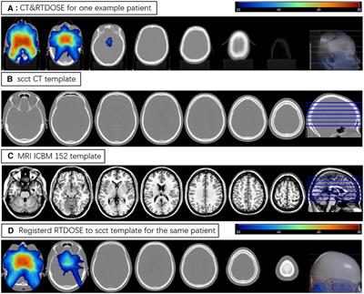 A detailed dosimetric comparative study of IMRT and VMAT in normal brain tissues for nasopharyngeal carcinoma patients treated with radiotherapy